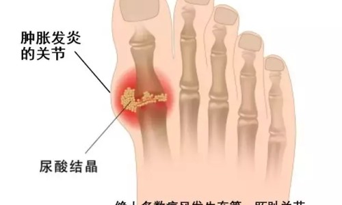 肝硬化病人能多吃香瓜网 | 肝硬化病人能多吃香瓜子吗,肝硬化病人能多吃香瓜吗